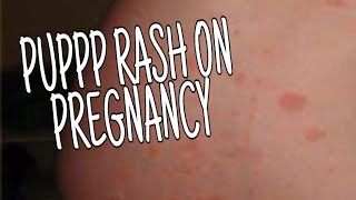 WHAT IS PUPPP  HOW TO TREAT PUPPP RASH ON PREGNANCY IN NATURAL WAYS [upl. by Yniatirb]