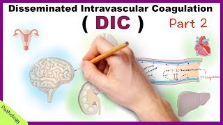 DIC Disseminated Intravascular Coagulation  Part 2 [upl. by Annayat679]