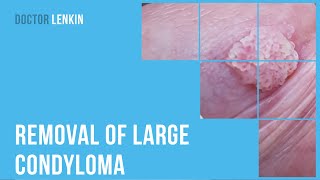 ✅ Removal of large condyloma on glans penis particularly in coronal sulcus [upl. by Corkhill]