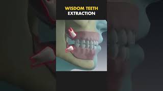 Wisdom Teeth Extraction intheknow educational trending educationalvideo dentalcare [upl. by Airtemad]