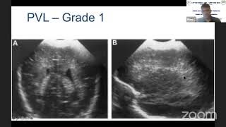 Neurosonogram [upl. by Burger]