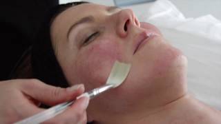 SkinCeuticals Phyto Corrective Masque Applied PostIPL Laser [upl. by Eenad]