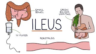 Understanding Ileus Paralytic Ileus [upl. by Spark788]