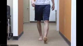 Clinical Gait Case Study Tibial Varum with Postop ACL complications [upl. by Iadam417]