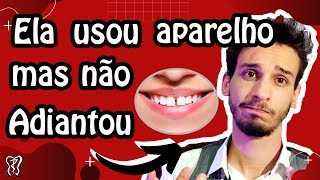 Diastema  O que é Como Fechar [upl. by Allin]