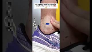 🔥Get Fair Feet  Easy Suntan Removal Pack At Home RemoveSuntan shortsytshortssuntandiyviral [upl. by Eesak702]