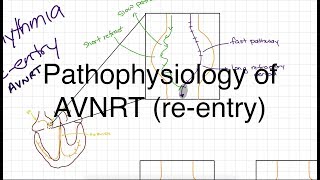 Pathophysiology of AVNRT [upl. by Devina]