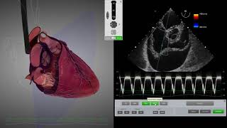 HeartWorks Cardiac Tamponade [upl. by Harneen124]