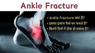 Ankle Fracture  टखने में fracture  anklepain anklefracture jharaayurveda [upl. by Zebada]