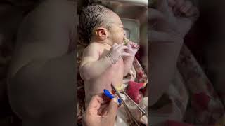 Cut umblical cords Baby born shorts youtubeshorts bornebaby newbornbaby viral [upl. by Suillenroc]