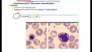 Sideroblastic AnemiaMicrocytic Anemia [upl. by Nahtanha]