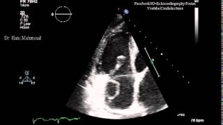 Right Atrial Thrombus [upl. by Kulda]