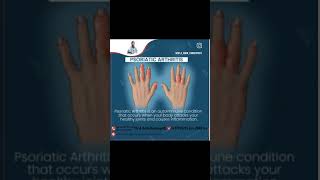 Psoriatic arthritis treatment [upl. by Asirb]