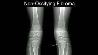 NonOssifying Fibroma 1 [upl. by Suivart]