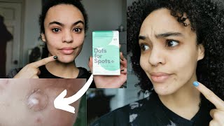 Dots For Spots Review  Do Spot Patches Really Work [upl. by Willabella]