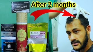 My 2 months of honest review on Saptarishi Ayurved Shree Kesh Hair Growth Oil treatment 🇳🇵 [upl. by Ayk244]