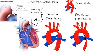 Coarctation of the Aorta  Symptoms Diagnosis and Treatment [upl. by Jansson]