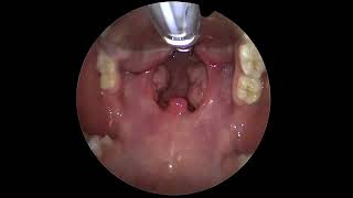 The Throat Exposure For Tonsillectomy Surgery [upl. by Charlean]