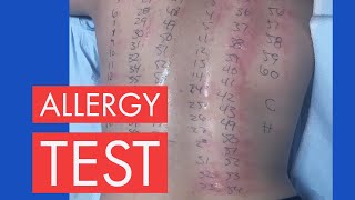 PRICK TEST ALLERGY TEST [upl. by Colman]