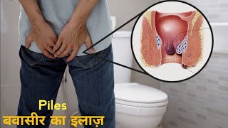 बवासीर Piles का इलाज़  Piles treatment  in Hindi pilespilesmedicine bawaseerkailaj बवासीर [upl. by Garber]