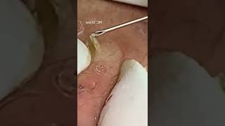 Pickel Ausdrücken Blackheads Mitesser Entfernung 🔴 61 [upl. by Vaas]