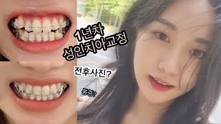 1년반차 성인 비발치 치아교정👄ㅣ교정과정 전후사진  스크류 통증 체중 및 얼굴변화 병원고르는팁 [upl. by Sherwood]