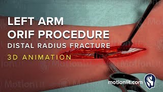 Left Arm ORIF Procedure of Distal Radius Fracture  3D Medical Animation [upl. by Ellatnahc]