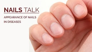 How Do Nails Help in Diagnosing Systemic Disease  Nail Abnormalities in Systemic Diseases [upl. by Smiley]