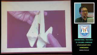 Dr James Hui Triplane and Tillaux Ankle Fractures [upl. by Antoinetta]