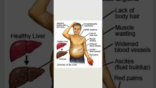 Cirrhosis of the livershortbiology [upl. by Notsla436]