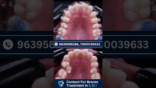 Braces Treatment Timelaps dentist facts dentalhygiene dentalclinic [upl. by Noired]