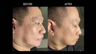 Pixel Pro Fractional laser technology to smoothen acne scar [upl. by Suzan753]