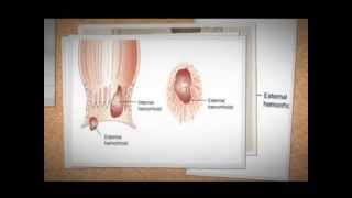 How to treat hemorrhoids  Hemorrhoids how to get rid of [upl. by Haridan]