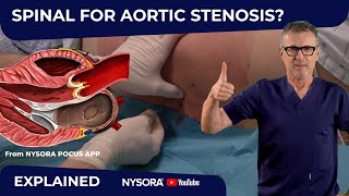 IS SPINAL ANESTHESIA IN AORTIC STENOSIS SAFE [upl. by Moll]