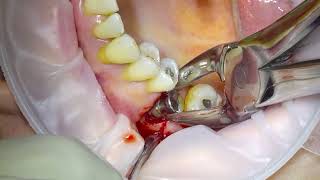 Removal of an Infected Dental Implant [upl. by Bethesda]