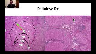 Cirrhosis treatment NEJM article summary [upl. by Aldric992]