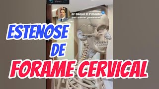 Redução da amplitude do forame cervical é a mesma coisa que estenose foraminal cervical [upl. by Jaqitsch]