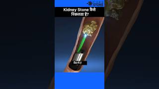 Kidney Stone treatment  laser treatment of ureteric stone  Shorts  RIRS [upl. by Dickerson362]