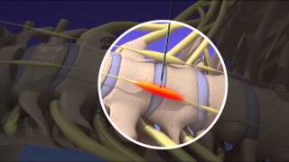 Stellate Ganglion Block [upl. by Ahsiat]