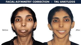 TMJ Temporomandibular Joint Ankylosis Treatment in India  Patient Review [upl. by Stefano]