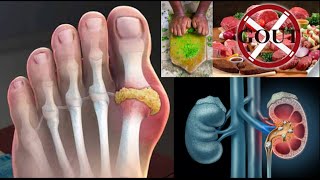 Uric acid gout and health [upl. by Weslee]