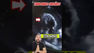 Derrame pericárdico que condiciona TAMPONADE 🫀 emergency [upl. by Ainalem883]