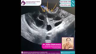 Egg Retrieval Procedure StepbyStep Guide  Asha IVF amp Fertility centre [upl. by Anpas266]