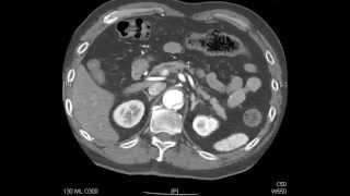 Aortic Dissection  QMH AED Ultrasound Casebook 201409 Video 7 [upl. by Enautna]