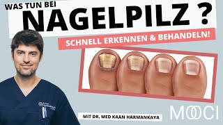 Nagelpilz schnell erkennen amp behandeln Das hilft [upl. by Aelsel]