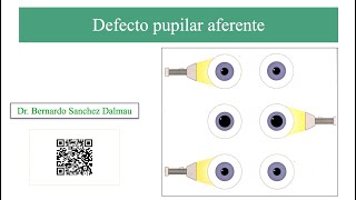 Defecto Pupilar Aferente Pupila de Marcus GunnTest de Iluminación Alternante [upl. by Ardnuat]