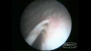 Endoscopic treatment for VUReflux  Deflux Injection [upl. by Ehtyde167]