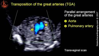 Fetal echocardiography at 1113 weeks Transposition of the Great Arteries TGA [upl. by Dita]