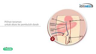 Vygon  Umbilical Catheters PVC [upl. by Agiaf]