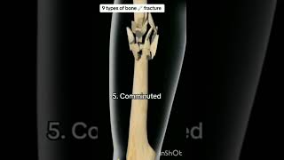 Types of bone fracture bones motivation trending shortsfeed shortvideo viralvideo science [upl. by Erwin]